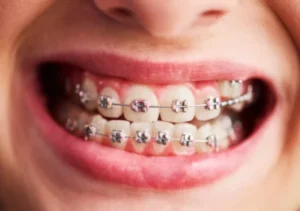 Ceramic Braces