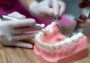 Dental Fillings