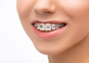 Orthodontics Near BTM