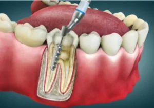 Root Canal Treatment